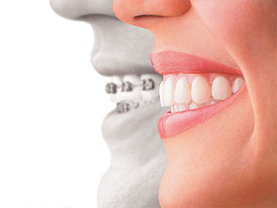 Mainland Dental Associates | Crowns amp Caps, Teeth Whitening and Dentures
